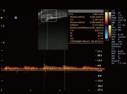 - Fingertips Vessle PW Mode Ebit50 Medical