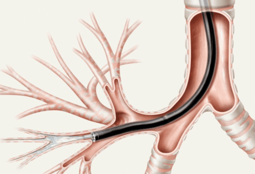 - ASPIRATION CATHETERS screen shot 2017 01 17 at 19.17.16